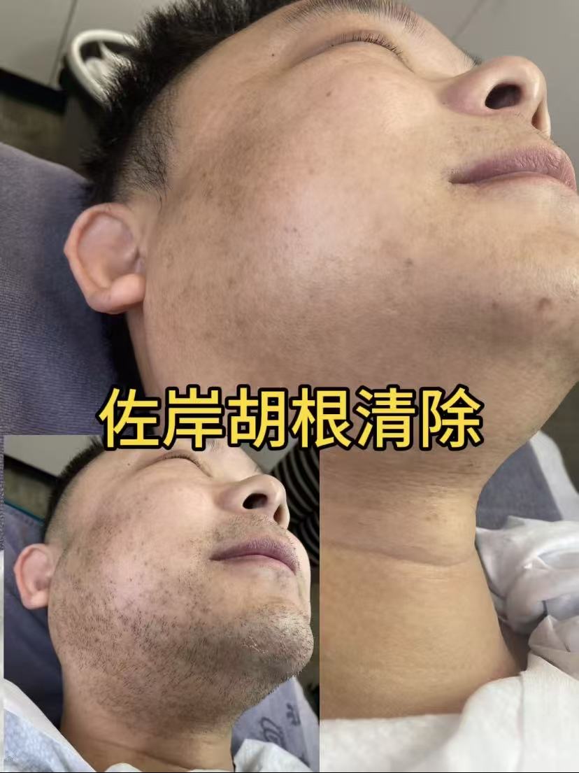 舟山脱毛